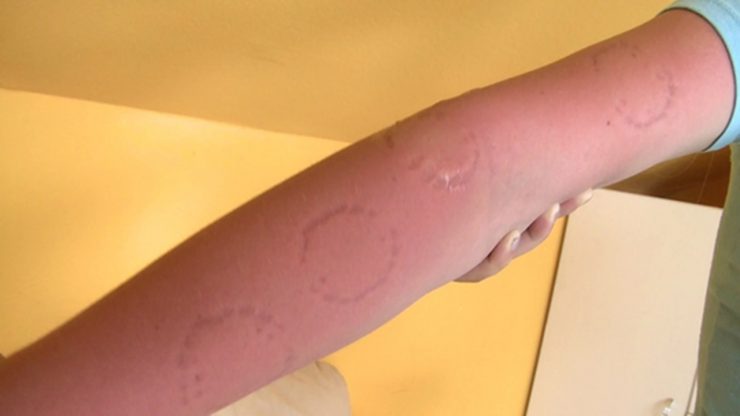 Hunterotic: Bite Girls – extreme bites – Domina Laura and Slave Gina